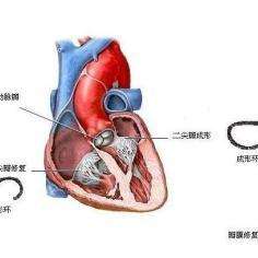 最新生物瓣技术，引领心脏瓣膜疾病治疗的新时代